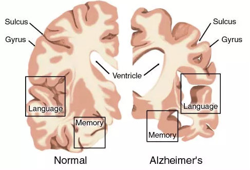 AD药物研发现状：辉瑞、礼来、百健、诺华、强生……