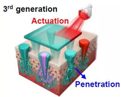 第三代：通过微针介导的皮肤层破坏和微针伴随的各种功能增强药物转运.jpg