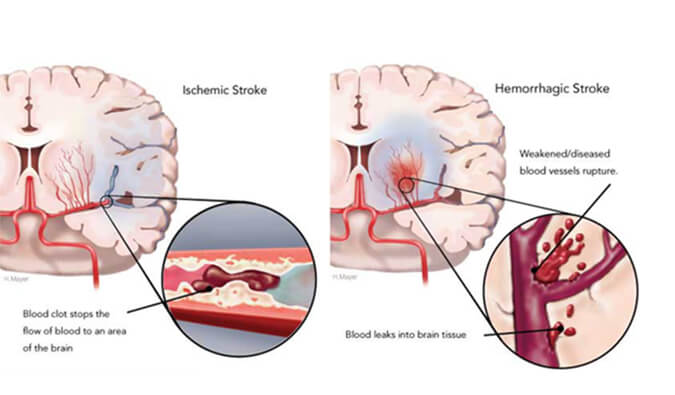 世界卒中日：从动物药效模型评价看心脑血管药物开发